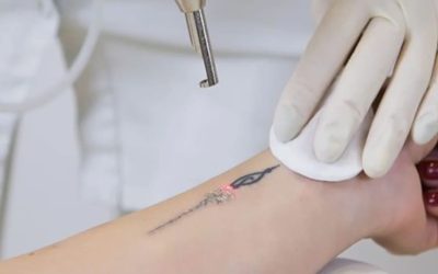Remoção de Tatuagens